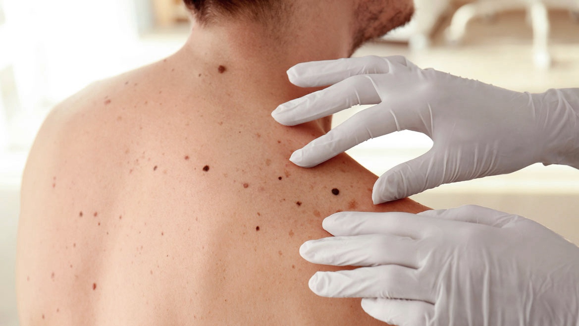 Lanzaron una campaña gratuita de revisión de lunares para prevenir el cáncer de piel