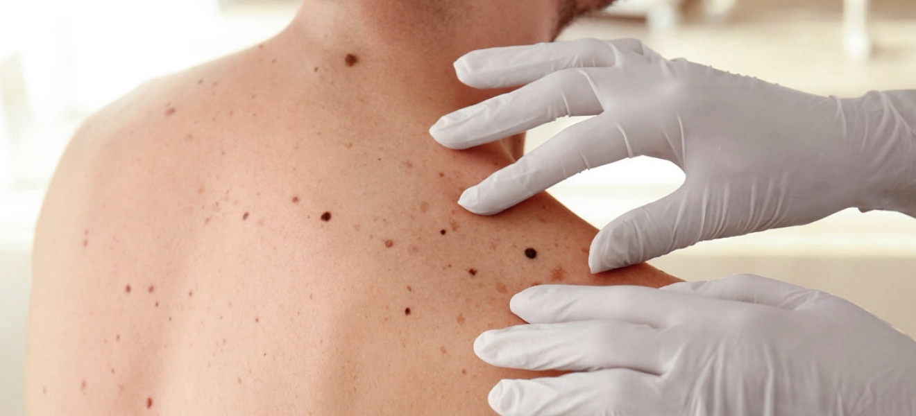 Lanzaron una campaña gratuita de revisión de lunares para prevenir el cáncer de piel